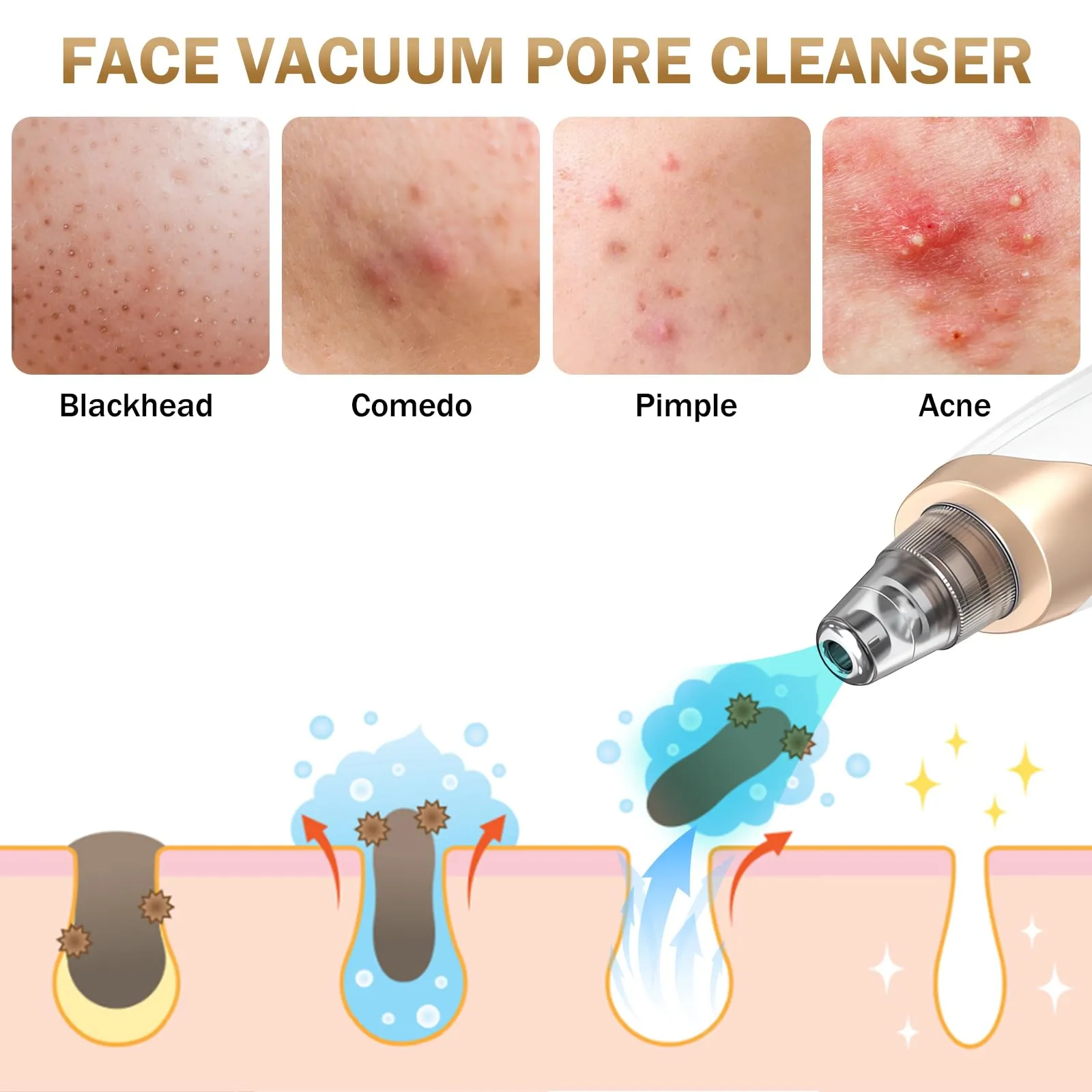 Blackhead Remover Pore Vacuum Kit - 2023 Upgraded Blackhead Extractor Tool with 3 Adjustable Suction Levels, 5 Probes, USB Rechargeable, Suitable for Women and Men